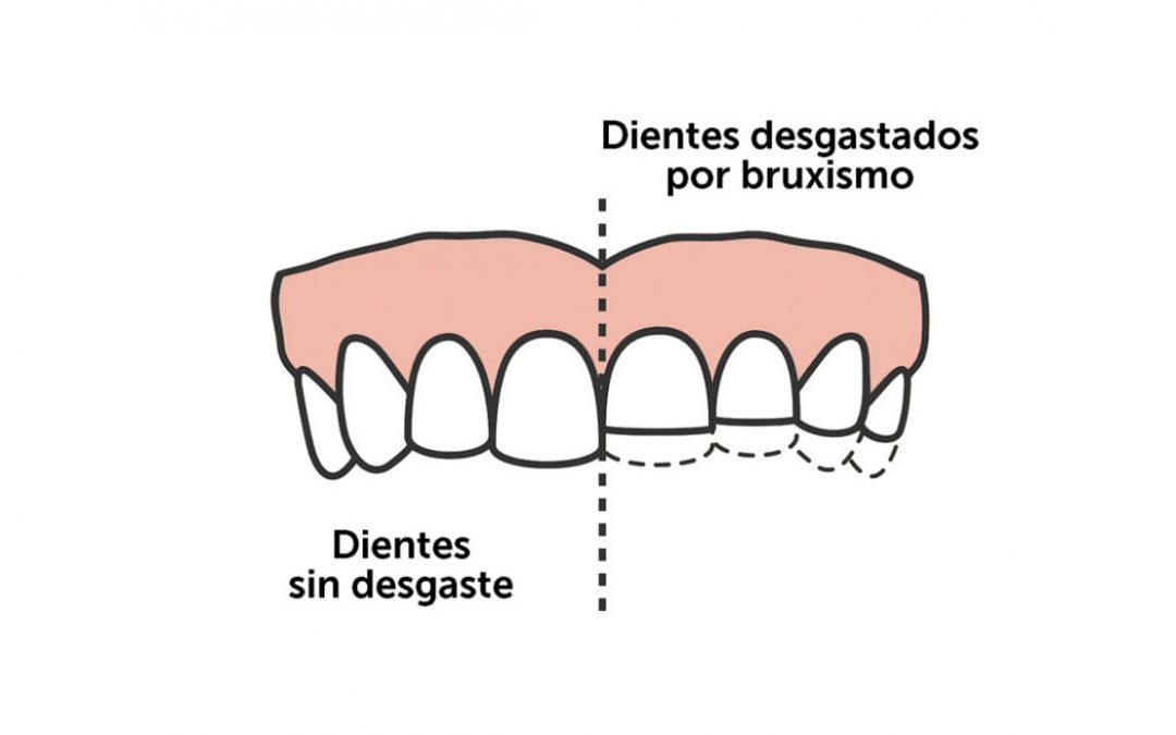 ¿QUE ES EL BRUXISMO?