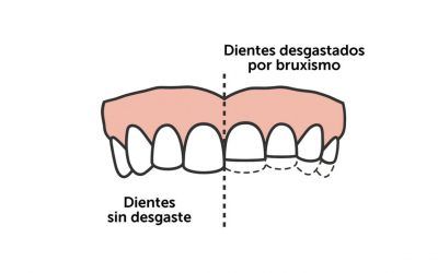 ¿QUE ES EL BRUXISMO?