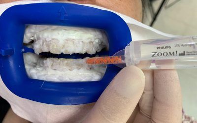 BLANQUEAMIENTO DENTAL.¿QUÉ ES?
