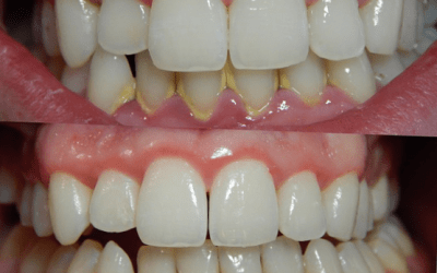 ¿QUÉ ES LA GINGIVITIS?
