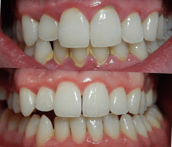 ¿QUÉ ES LA GINGIVITIS?