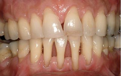 ¿QUÉ ES LA PERIODONTITIS?