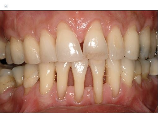 ¿QUÉ ES LA PERIODONTITIS?