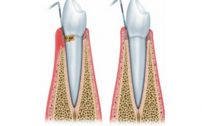 GINGIVITIS Y PERIODONTITIS