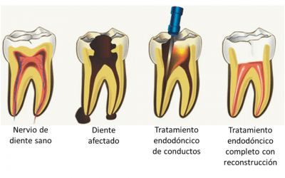 ¿QUE ES UNA ENDODONCIA?