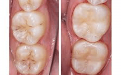 ¿QUÉ ES UN EMPASTE DENTAL Y PARA QUÉ SIRVE?