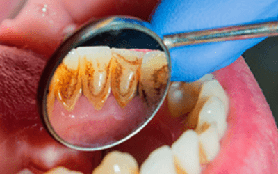 DIFERENCIAS ENTRE RASPADO Y LIMPIEZA DENTAL