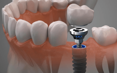 IMPLANTES DENTALES