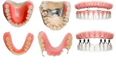 ¿QUÉ HACER SI SE ROMPE MI PRÓTESIS DENTAL?