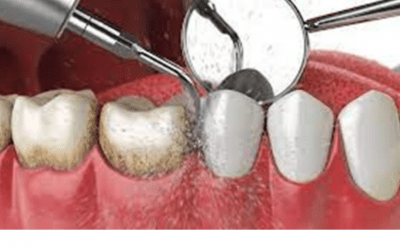 LIMPIEZA DENTAL POR ULTRASONIDO